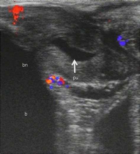 can guys squirt|Male squirting: Analysis of one case using color Doppler ...